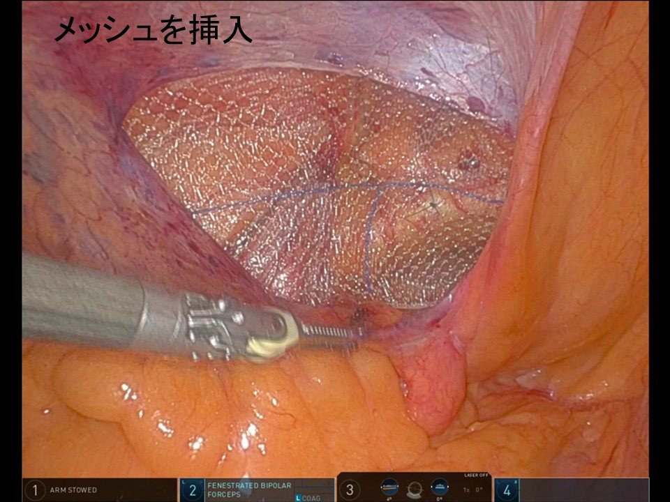 メッシュを挿入