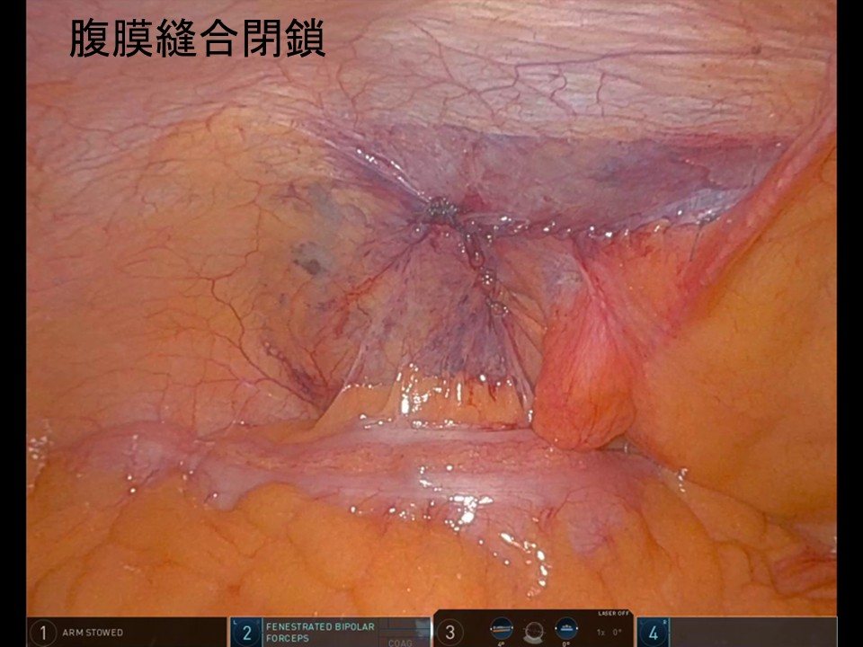 腹膜縫合閉鎖